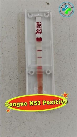 Dengue NS1 test | Dengue test | Dengue fever | Dengue positive test