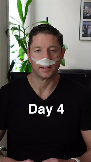 Septoplasty Recovery #deviatedseptum