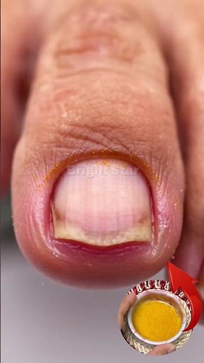 Stubborn toenail fungus!Simple home care + consistency = healthy nails again 💚🦶