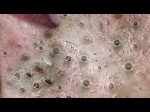 Deep blackhead Removal 2026, acne removal spa, big pimple 2026, #acne #pimple #cyst