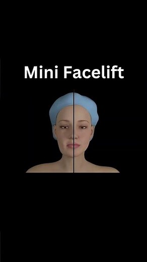 Cosmetic Mini Facelift Surgery | 3D Animation 👁️