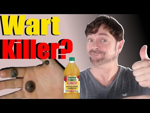 EASY! Remove Warts with Apple Cider Vinegar | 3 Steps! | Chris Gibson