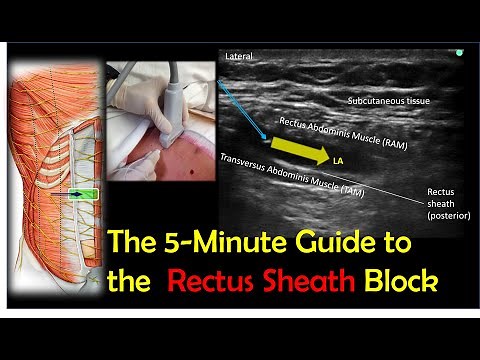 Rectus Sheath Block - A How-To Guide