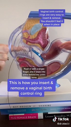 Easy Guide to NuvaRing, EluRyng, and Annovera