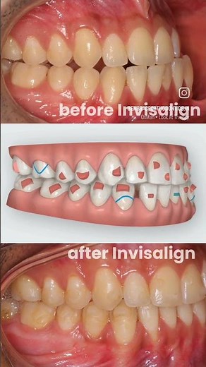 Class 3 Anterior Crossbite correction with Invisalign. #invisalignbeforeandafter #beforeandafter