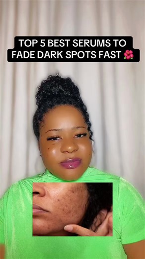 If you are tired of those stubborn dark spots, dull skin or hyperpigmentation add any of these serums to your routine. To order 08160088882 #skincarerecommendations #skincarevendor #skincaretiktok #hyperpigmentation #darkspots