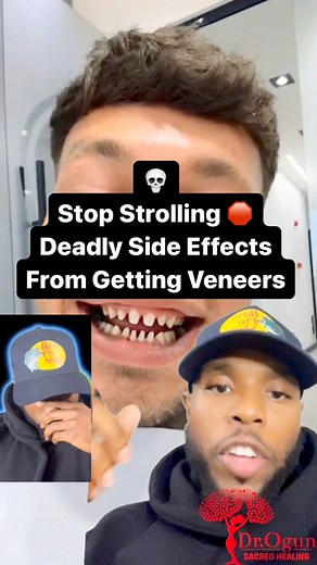 The Truth About Veneers 🤯_____________Check Out Our Most Popular Products: 1. Ultimate Health Guide 2. Alpha Energy “Male Tonic” 3. The Womb “Women Tonic”Available at: DROGUNBOLOK.COM | Dr. Ogun Sacred Healing