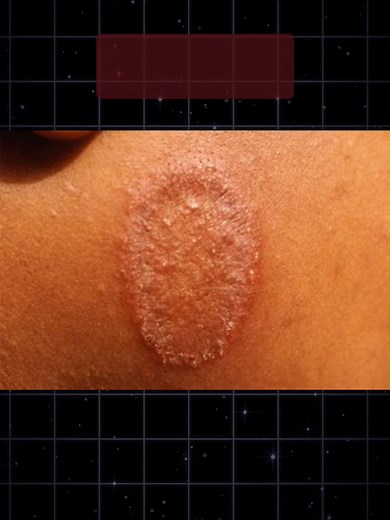 OSCE Spot Diagnosis: Tinea (Ringworm) Diagnosis & Treatment