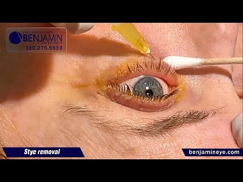 Live Stye Removal Procedure | Expert Eye Care at Benjamin Eye Institute
