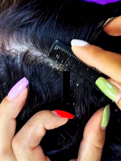 14K views · 51 reactions | Dandruff Scratching And Picking Scalp #DandruffScratching #ItchyDryScalp #HugeFlakes #Dandruff #dandrufftreatment #satisfying #dandruffremoval Disclaimer: Videos do not show original Dandruff, they are used for education purpose. Thank You,,,, | The Filmy | Facebook