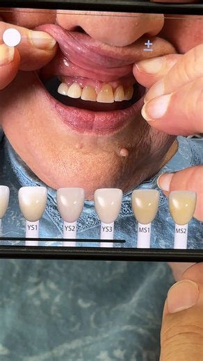 using the digital shade guide in the LSK121 App for cosmetic dentistry again in my lab today | Luke Kahng