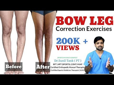 Bow Legs Correction Exercises in hindi | Bow leg correction at home | How to fix bowed legs