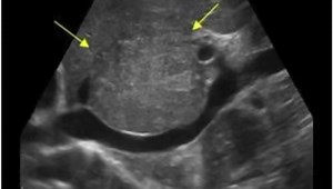 2.9K views · 87 reactions | Focal Nodular Hyperplasia image credit: www.ultrasoundcases.info | John Z Wetmore | Facebook