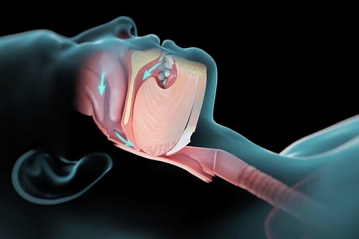 Sleep Disorder Symptoms Treated by Top Rated Lung Doctors at Mercy