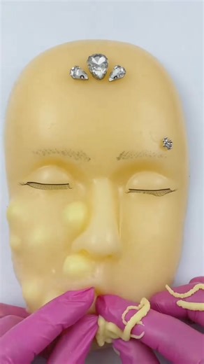 Remove pimples face the most relaxing satisfying pimple popping #capcut #asmr #asmrtiktoks #viralvideo #fyp #pimples #pimple_popper_asmr #tingles #asmrtingles #asmrtriggers #asmrsounds #mouthsounds #acnetreatments #mochipimplepopping #bonniepimplepopperasmr | Bonnie Pimple popperr