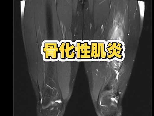 骨化性肌炎（myositis ossificans, MO），发生于肌肉及软组织内的局限性、孤立性伴有反应骨形成的纤维母细胞增生性病变。