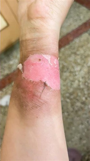 मेरा जला हुआ हाथ इतनी जल्दी कैसे ठीक हो गया #dailyroutine #dailylifevlogs #dailyshorts #shorts #vlog