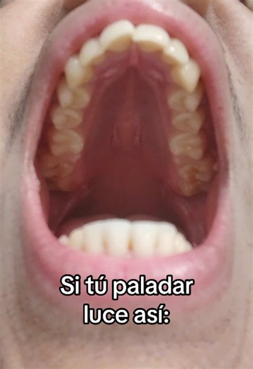Cómo crear el vacío intraoral con la lengua
