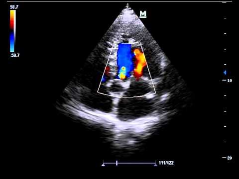 understanding colour Doppler in one minute
