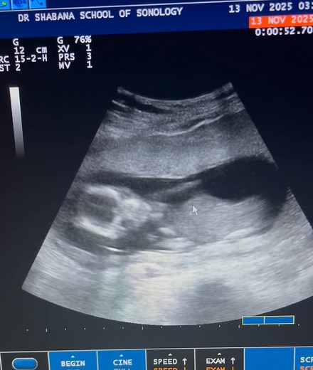 7.5K views · 171 reactions | Fetal movements are seen with normal tone and activity. Fetal breathing movements are noted. Intermittent rhythmic diaphragmatic movements consistent with fetal hiccups are observed, indicating normal fetal wellbeing. Amniotic fluid volume is adequate and placental appearance is normal | Dr. Shabana's School of Sonology. | Facebook
