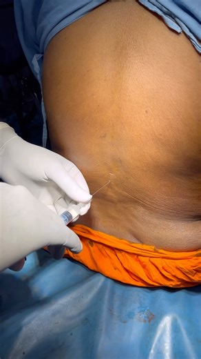 Spinal Anaesthesia procedure 💉#mbbs #doctor #hospital #sortfeed #sorts