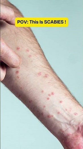 POV: This is scabies
