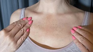 Close-Up of Woman’s Chest Showing Pigmentation, Dark Spots, and Skin Imperfections – Natural Skin Tone, Sun Damage, Freckles, and Hyperpigmentation Treatment Concepts for Skincare and Beauty Awareness