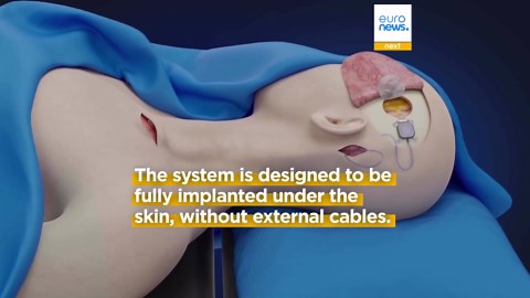 Paralysed man controls devices with his mind just five days after brain implant surgery in China