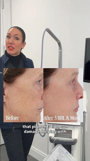 Moxi and BBL for Skin Rejuvenation