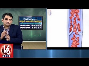 Varicose Veins Problem | Symptoms & Treatment | Dr Abhilash Sandhyala | Good Health | V6 News
