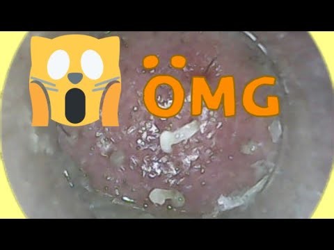 Deep Acne Popping:Pimple Extraction:Satisfying Pimple Popping:Professional Acne Extraction Facial:
