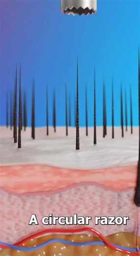 How does a hair transplant actually work? 🤔 At Wolf Hair Restoration, we use advanced FUE hair transplant techniques to move healthy hair follicles from the donor area (typically the back of the scalp) to thinning or balding areas. Each graft is placed strategically to create a natural hairline and long-term, permanent hair growth. ✔️ Minimally invasive ✔️ No linear scar ✔️ Natural-looking density ✔️ Permanent solution to hair loss If you’re searching for hair transplant near me, FUE hair resto