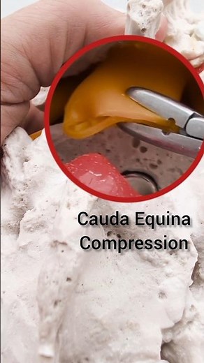 Cauda Equina Compression Model - Dynamic Disc Designs