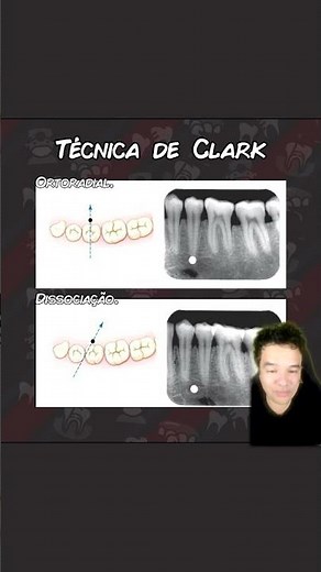 Descubra Como Funciona a Técnica de Clark - Resumo - Concurso Odontologia #shorts