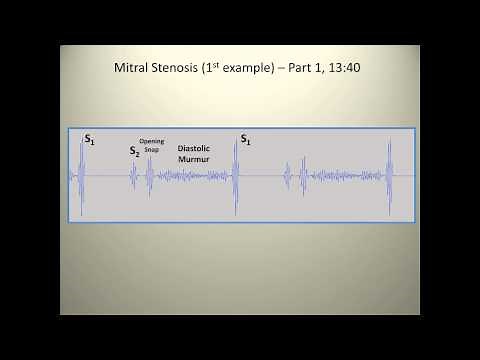 Examples of mitral stenosis murmurs
