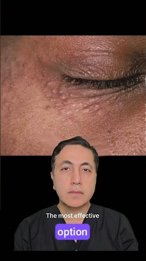 Under-Eye Syringomas Explained in 60 Seconds | Causes & Treatment