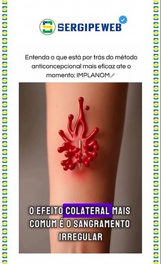 💉🧬 IMPLANON: COMO FUNCIONA O “ANTICONCEPCIONAL DO BRAÇO”?