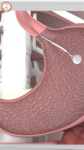 Foreign Body Removal by Endoscopy | 3D Medical Animation for GI Procedure