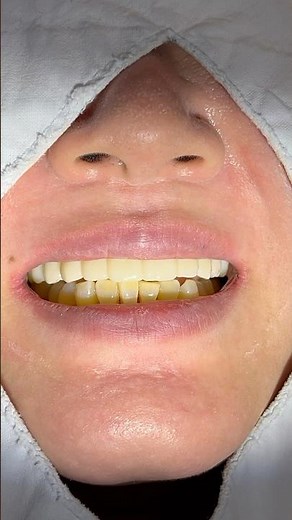 🧑🏻‍🎤💐40대 여성 위전체임플란트 치료과정 40s female full implant process #dental #implnats