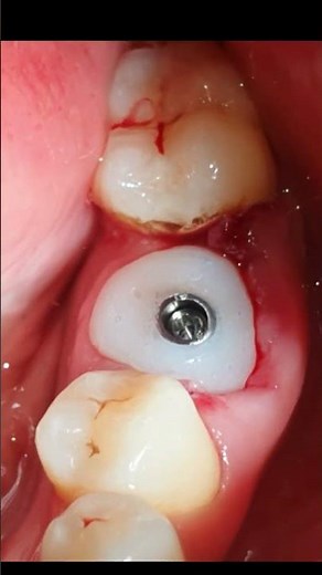 Immediate implant placement with Custom abutment
