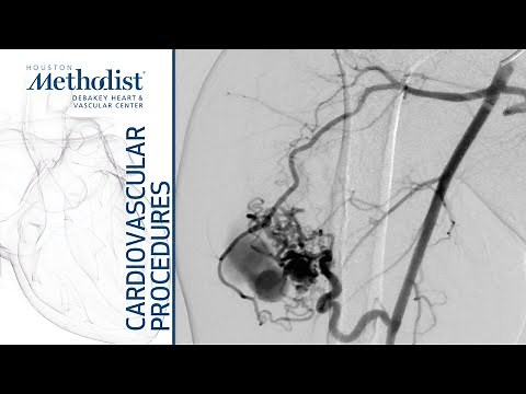 Onyx Embolization of Arteriovenous Malformation of Right Upper Arm (A. Lumsden, MD, M. Zubair, MD)
