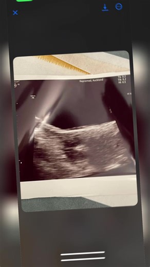 IVF Frozen Embryo Transfer Success in 2025