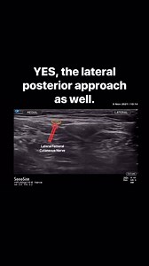 El nervio cutáneo femoral lateral (LFCN) se divide en varias ramas que inervan las caras lateral y anterior del muslo. La anatomía variable del nervio cutáneo femoral lateral dificulta la realización de un bloqueo eficaz basado en puntos de referencia. ANATOMÍA DE ULTRASONIDO La LFCN generalmente se visualiza entre el músculo tensor de la fascia lata (TFLM) y el músculo sartorio (SaM), 1 a 2 cm medial e inferior a la espina ilíaca anterosuperior (ASIS) y 0.5 a 1.0 cm por debajo de la superficie 
