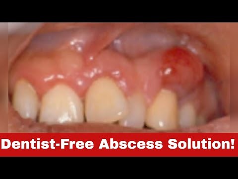 5 Simple Tricks: How to Get Rid of a Tooth Abscess Without Going to the Dentist!