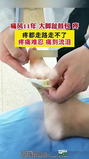 本地脚趾关节、手指关节红肿发热疼痛，是痛风吗？试试这个方法！