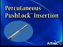 Percutaneous PushLock® Insertion