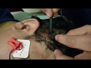 Non Surgical Treatment for Hemi Facial Spasms