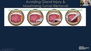 Endoscopic Endonasal Pituitary Adenoma Surgery