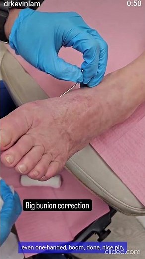 8 Weeks Post-Op Bunion Surgery ✅ Pin Removal & Healing Progress | Dr. Kevin Lam #bunions