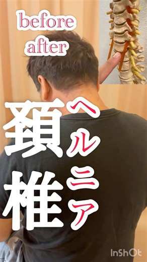 【頸椎ヘルニアbefore &after】痛み・しびれ10→1くらい 可動域改善：広島県広島市中区の整骨院・整体院「かわら町整骨院」